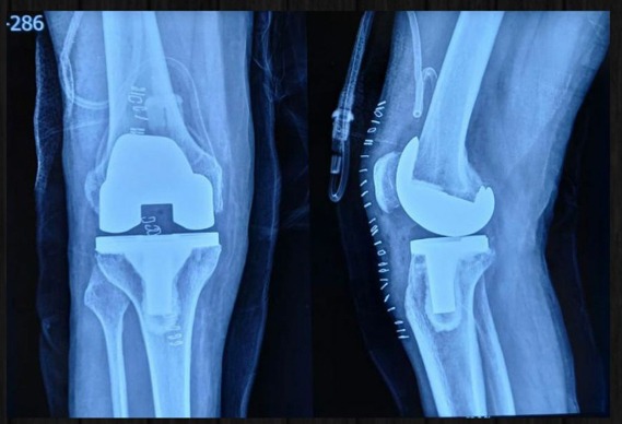 Knee Replacement