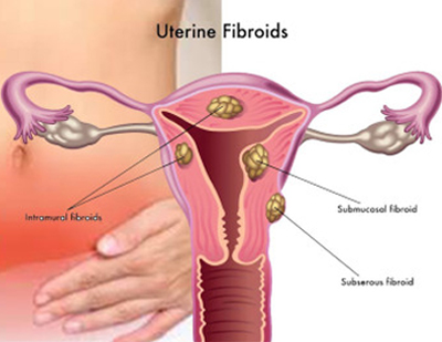 Laparoscopic Myomectomy