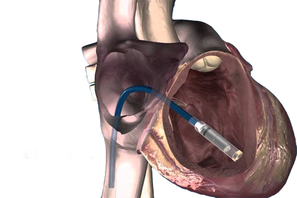 Cardiac Pacing and Device Implantation
