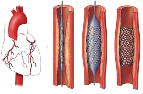 Coronary Intervention