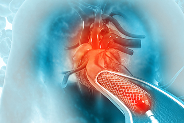Structural Heart Intervention