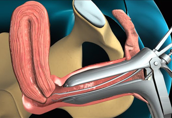 D/C Biopsy