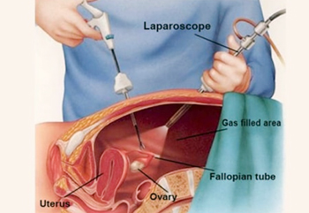 Lap Ligation