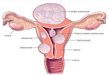 Myomectomy