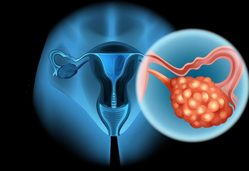 Operation of Ovarian Tumors