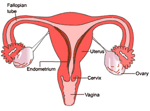 endometriosis