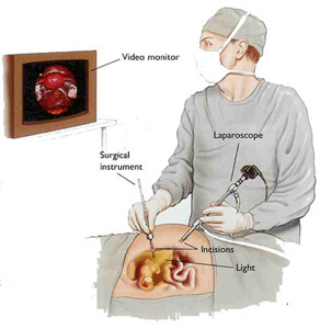 endometriosis