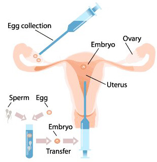 infertility
