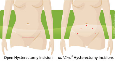 ovarian cysts