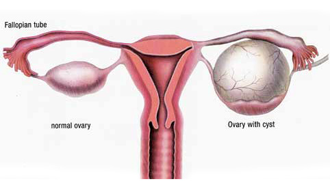 ovarian cysts