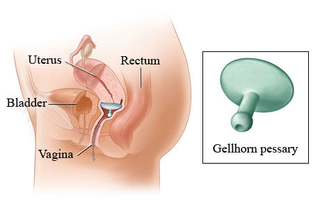 Pelvic Organ Prolapse 