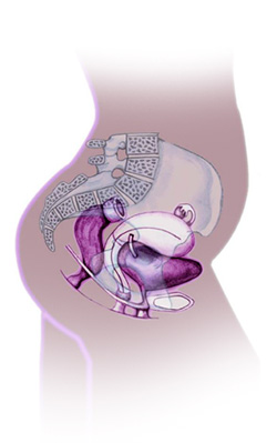 Pelvic Organ Prolapse 
