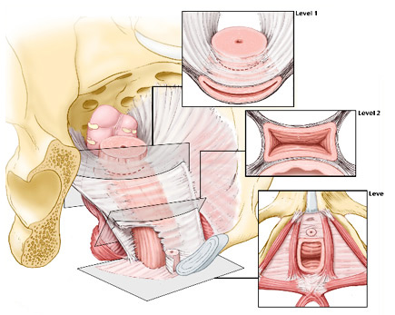 Reconstructive pelvic surgery