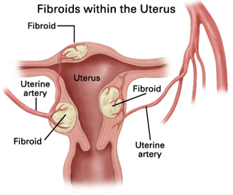 uterine fibroids