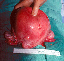uterine fibroids